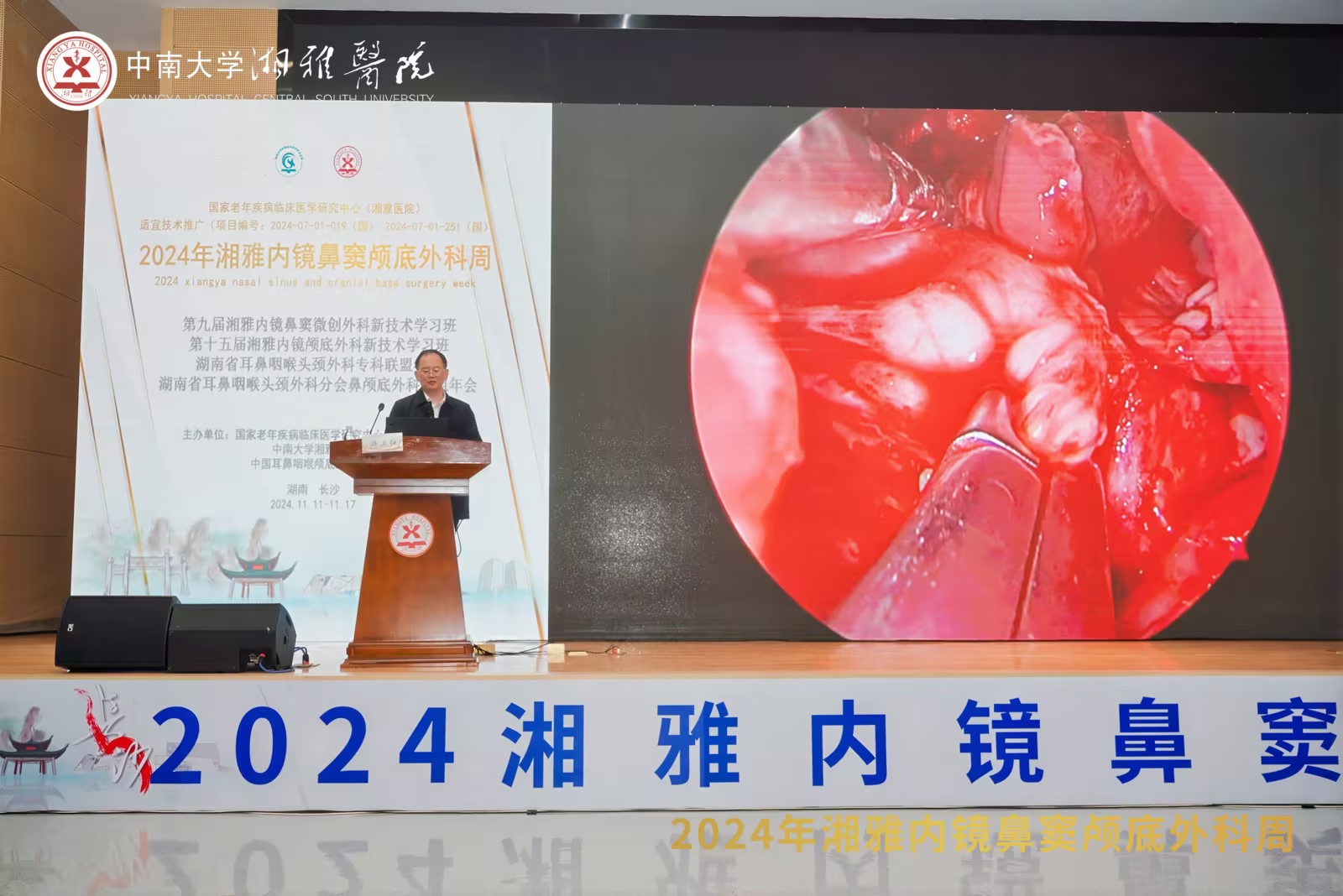 夹式双级、、钨针术中利用亮相2024湘雅内镜鼻窦颅底外科周